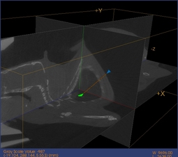 Using MicroView to plan the intervention